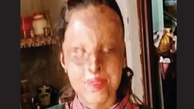 Life Success Story: एसिड अटैक से चली गई आंखें, लेकिन नहीं हारी हिम्मत, 10वीं परीक्षा में किया टॉप